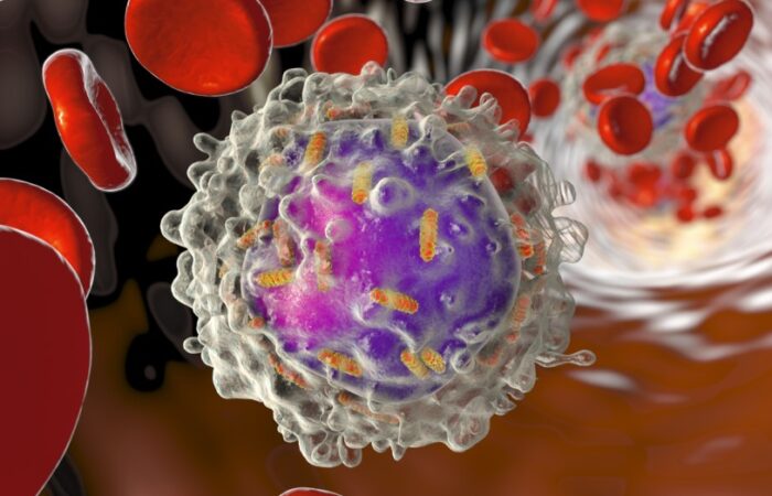 خلية مصابة بالابيضاض اللمفاوي