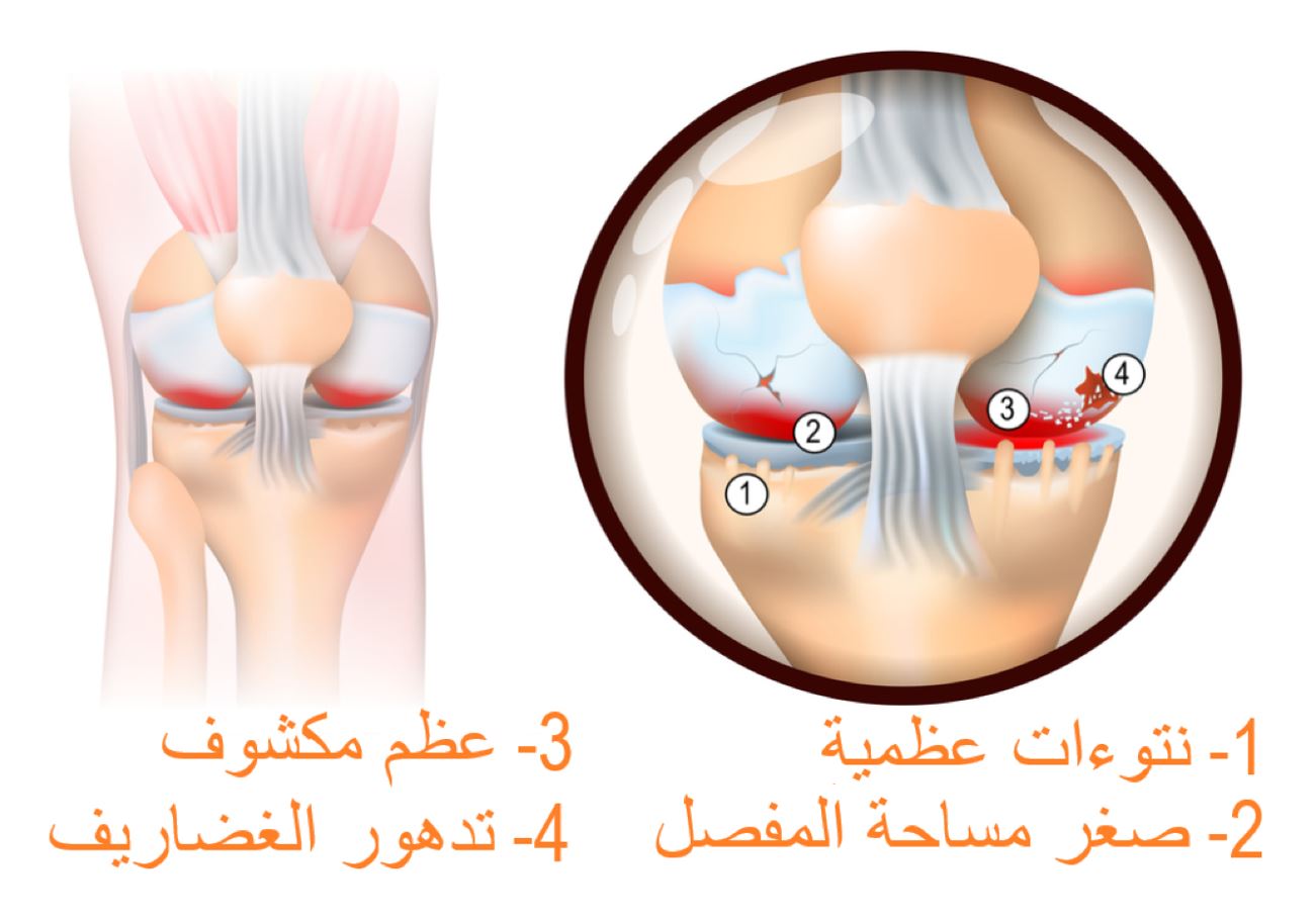 رسم توضيحي لمفصل متهالك مصاب بمرض الفصال العظمي