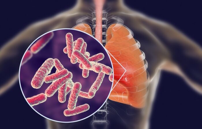 رسم توضيحي لجرثومة السل متواجدة في الرئتين