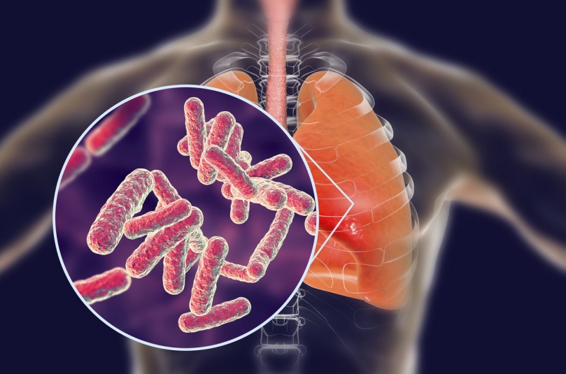 رسم توضيحي لجرثومة السل متواجدة في الرئتين