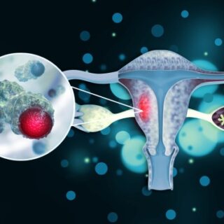 رسم توضيحي لخلية سرطانية متواجدة داخل الرحم