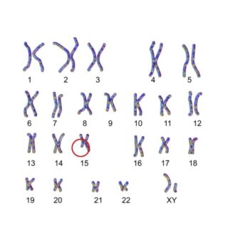 رسم توضيحي يظهر خلل جيني بالصبغي رقم 15