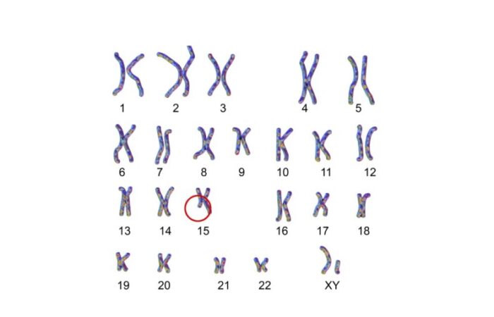 رسم توضيحي يظهر خلل جيني بالصبغي رقم 15