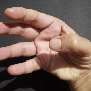 أصابع يدّ إنسان ويظهر الإبهام في هذه اليد بشكل غير طبيعي
