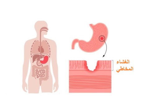 رسمة توضيحية لمعدة إنسان مصابة بتقرح