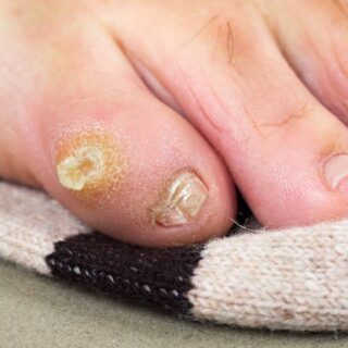 أصابع قدم لشخص بالغ مصابة بتقرح جلدي