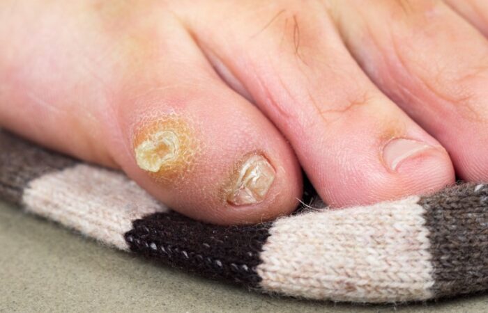 أصابع قدم لشخص بالغ مصابة بتقرح جلدي