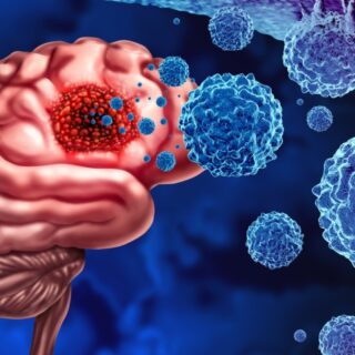 رسمة دماغ مصاب بخلايا سرطانية