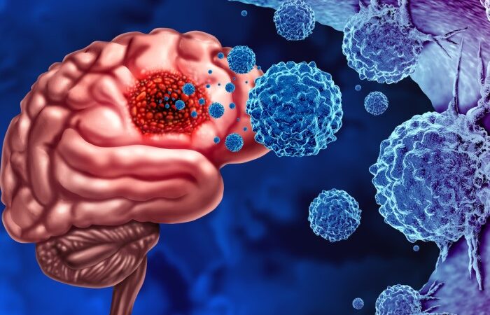 رسمة دماغ مصاب بخلايا سرطانية