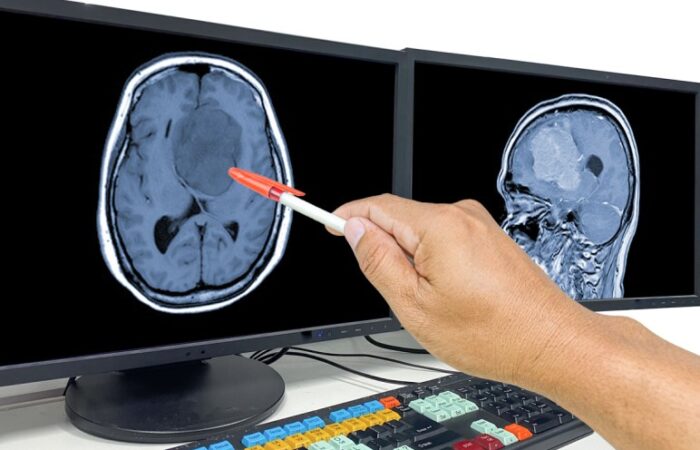 تصوير شعاعي للدماغ على شاشة الكمبيوتر ويقوم الطبيب بالإشارة الى مشكلة في صورة الدماغ