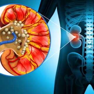 رسم توضيحي للكلية عند الإنسان يوجد بداخلها حصيات