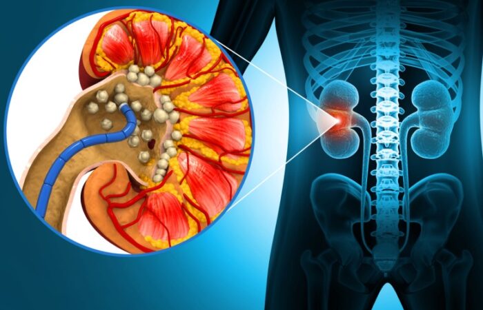 رسم توضيحي للكلية عند الإنسان يوجد بداخلها حصيات