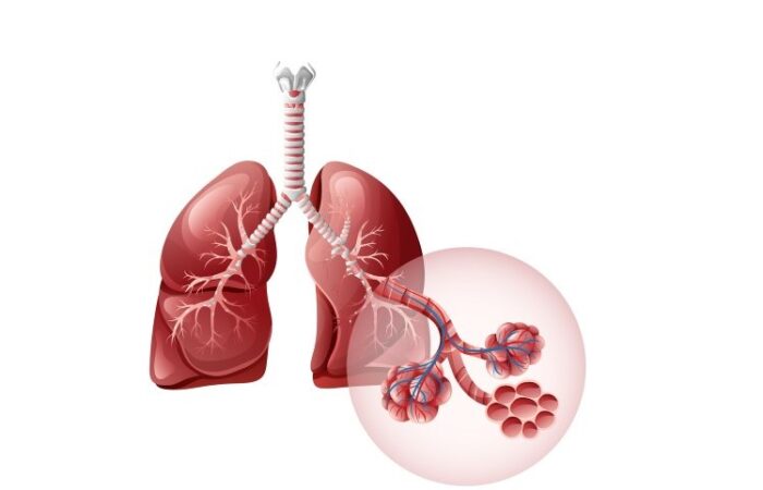رسم توضيحي لرئة مصابة بانسداد الشعب الرئوية