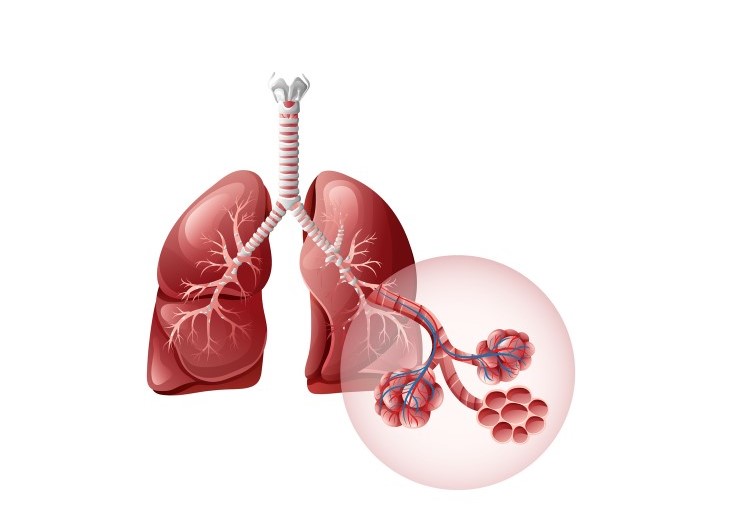 رسم توضيحي لرئة مصابة بانسداد الشعب الرئوية