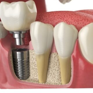 رسم توضيحي لعملية زراعة السن داخل النسيج العظمي للفك باستخدام برغي أسفل السن