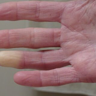 راحة يد إنسان بالغ ويظهر الجلد بشكل جاف ومُجعّد