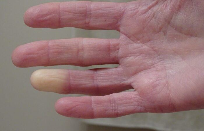 راحة يد إنسان بالغ ويظهر الجلد بشكل جاف ومُجعّد