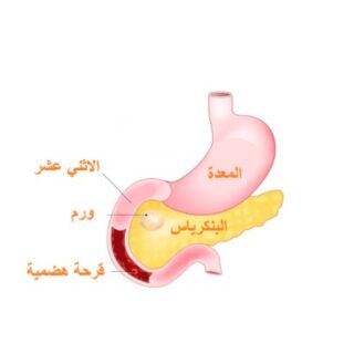 رسم توضيحي لورم يصيب البنكرياس