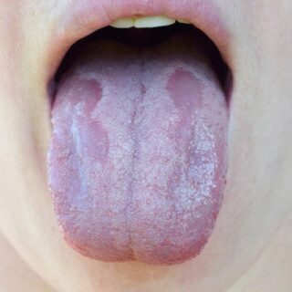 لسان لونه أبيض