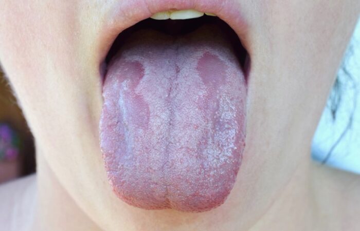 لسان لونه أبيض