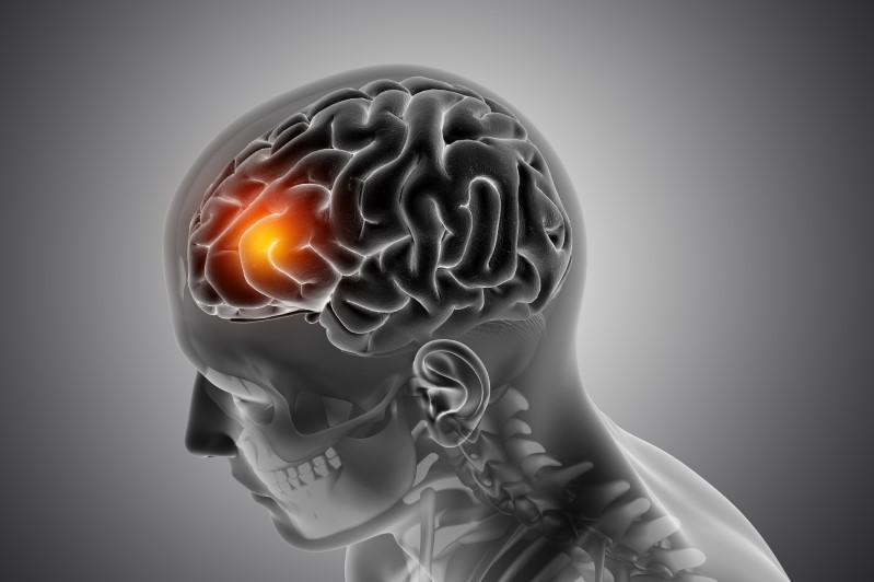 رسم ثلاثي الأبعاد لرأس شخص يظهر فيه ورم داخل الدماغ