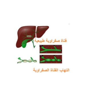 رسم توضيحي للكبد والتهاب القناة الصفراوية