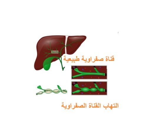 رسم توضيحي للكبد والتهاب القناة الصفراوية