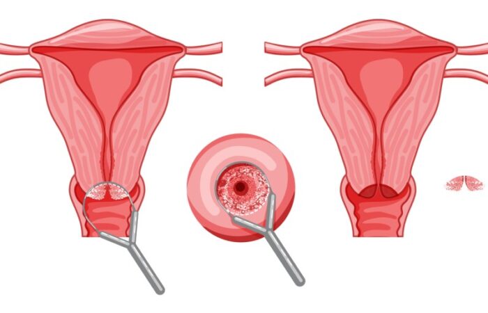 رسم توضيحي لخزعة من عنق الرحم