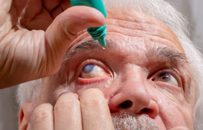 شخص مسن يقوم بقطر الدواء بعينه التي يظهر فيها بياض في البؤبؤ