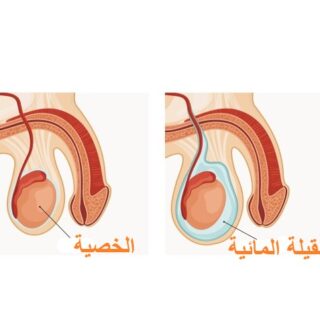 رسم توضيحي لتموضع القيلة المائية ضمن الخصية