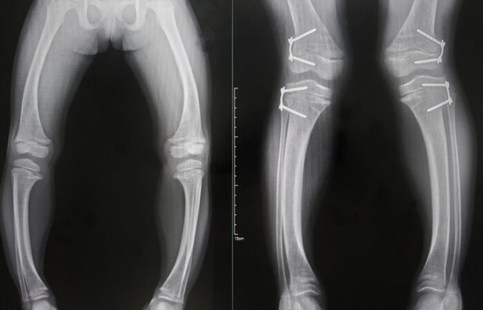 صورة أشعة سينية للساقين