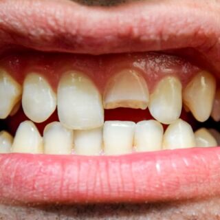 سن مكسور في الفك العلوي من الفم