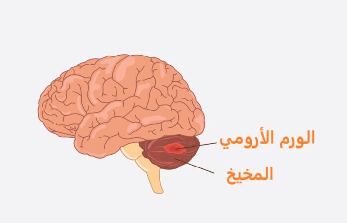 رسم توضيحي لورم موجود داخل المخيخ