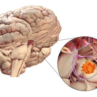 ورم موجود بالمخيخ