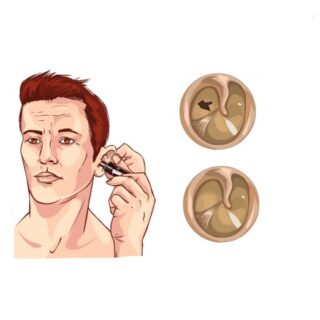 وجه إنسان وبجانبه رسم لغشاء طبل أذن طبيعي وغشاء طبل مثقوب