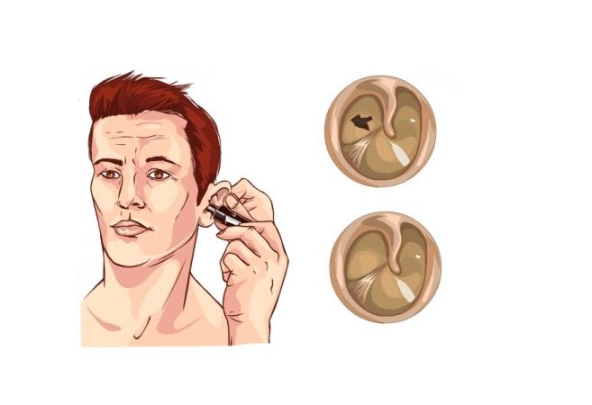 وجه إنسان وبجانبه رسم لغشاء طبل أذن طبيعي وغشاء طبل مثقوب