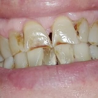 أسنان مُتآكلة لشخص بالغ