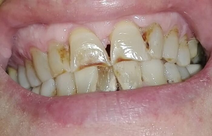 أسنان مُتآكلة لشخص بالغ