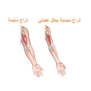 ذراع سليمة وذراع مصابة بضمور عضلي