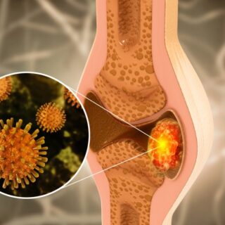 خلية سرطانية متموضعة ضمن عظام الركبة