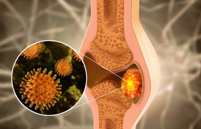 خلية سرطانية متموضعة ضمن عظام الركبة