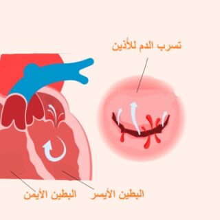 رسم توضيحي لقصور الصمام التاجي