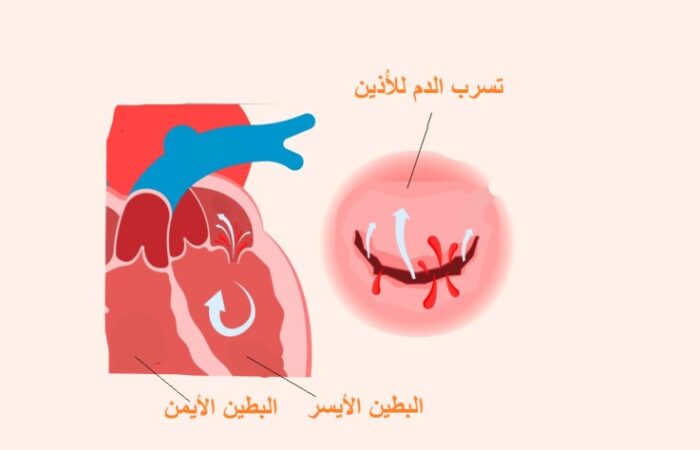 رسم توضيحي لقصور الصمام التاجي