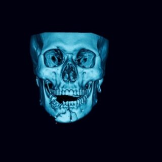 رسم ثلاثي الأبعاد لوجه يظهر فيه كسر الفك السفلي