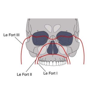 رسم توضيحي للجمجمة وكسور الفك العلوي