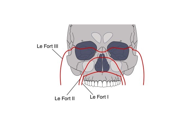 رسم توضيحي للجمجمة وكسور الفك العلوي