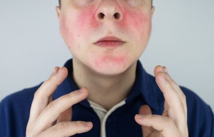 شاب يعاني من احمرار في وجهه بمنطقة الخدود والذقن
