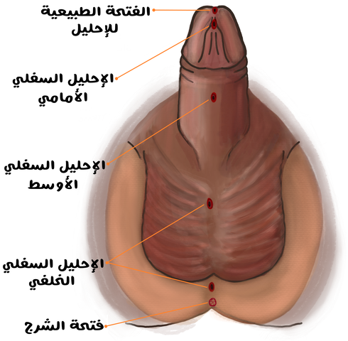 رسم توضيحي للجهاز التناسلي عند الأطفال الذكور وتظهر فتحات الإحليل أسفل القضيب في القسم الأمامي والأوسط والخلفي منه