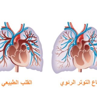 رسم توضيحي لشكل القلب الطبيعي وارتفاع التوتر الرئوي