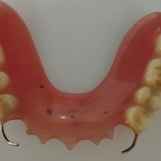 بدلة أسنان على الطاولة ويظهر سلكين معدنيين من طرفي البدلة